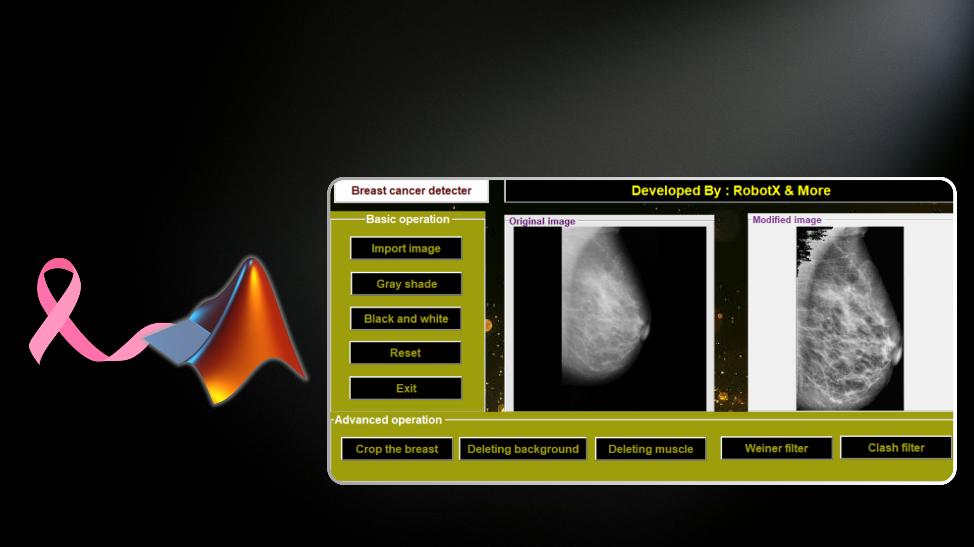 Breast Cancer Detection System UI